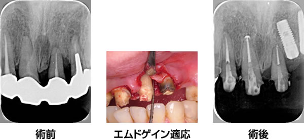 エムドゲイン治療症例