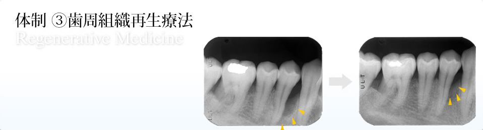 ③歯周組織再生療法 / Regenerative Medicine