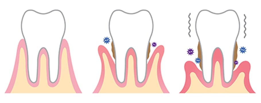 歯周病